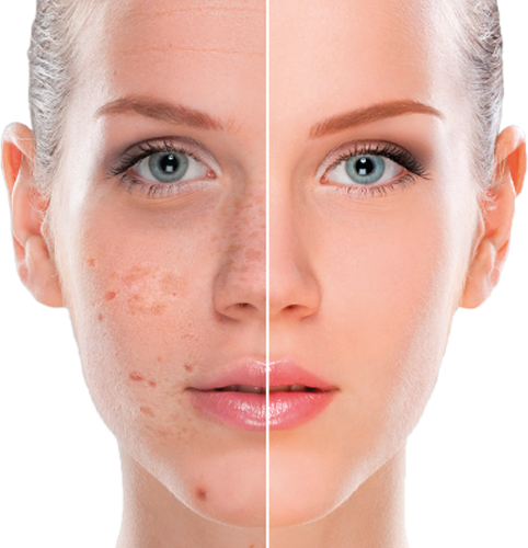 Hyperpigmentation Peel Facial Toronto