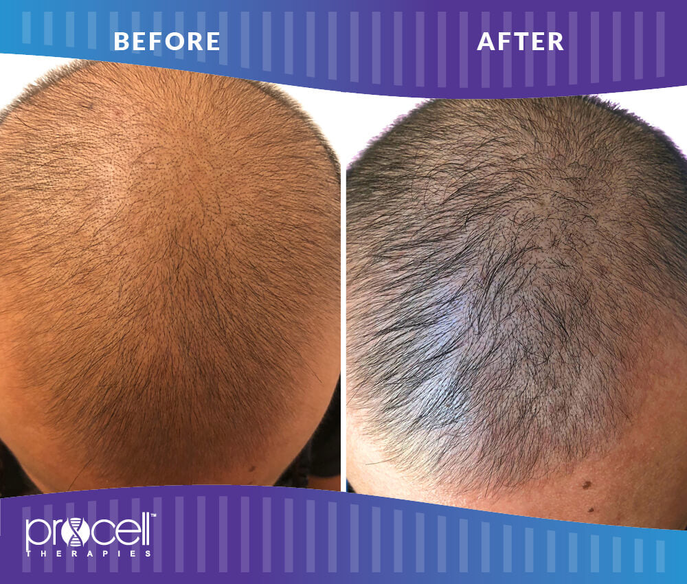 procell hair restoration treatment Toronto