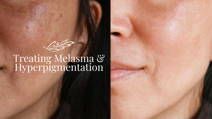 Treating Melasma & Hyperpigmentation with Cimel Professional Peels