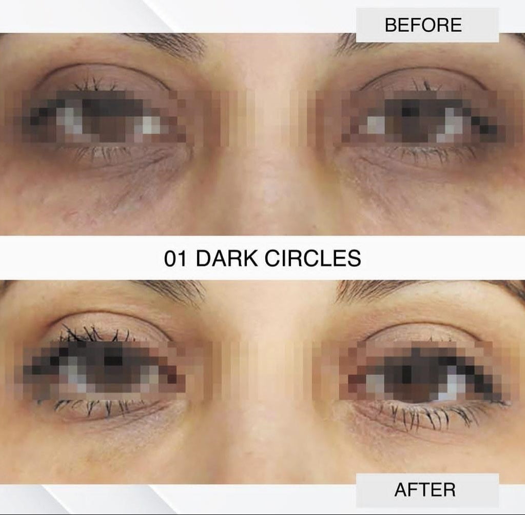 Dark Circles